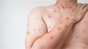 我國第5例「猴痘」！ 30多歲男出現水泡、皮疹等...