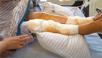 3犬隻突襲擊追咬！彰化76歲婦全身「200多處傷...