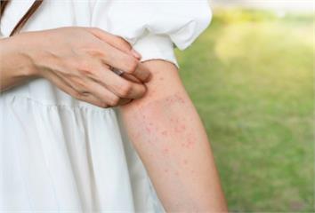 「乾燥症」不是只有乾燥而已！ 皮膚長紅疹也是症狀...