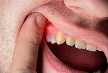 別以為只是火氣大！醫揭「牙齦腫脹6原因」  牙刷...