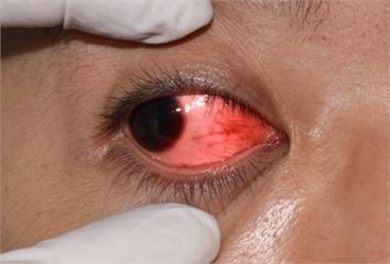 配戴隱形眼鏡習慣不良　感染棘阿米巴導致角膜潰瘍需...
