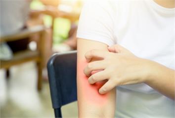 尿毒性搔癢症折磨慢性腎友　整合治療助恢復睡眠與生...