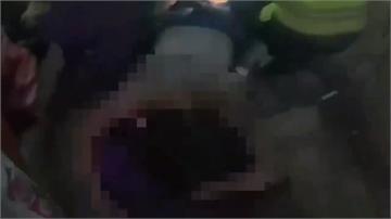 男緊張吞「3顆子彈」引發鉛中毒！ 跌地下室腿骨折...