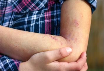 花錢找偏方反增痛苦！異膚病友呼籲：回歸正規治療才...