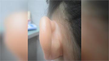 7歲女童戴成人口罩　耳後竟長1公分腫瘤