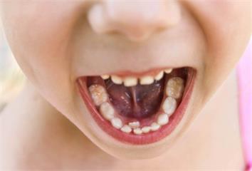 幼兒蛀牙反正會換牙沒關係？  專科醫師揭「嚴重下...
