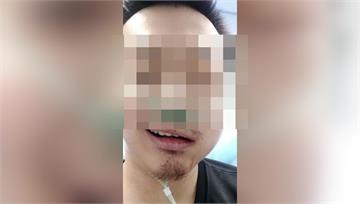 拔牙時臉突腫脹「如吹氣球」 醫曝「皮下氣腫」嚴重...