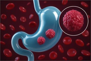 預防胃癌再升級！115年起全面推動公費幽門螺旋桿...