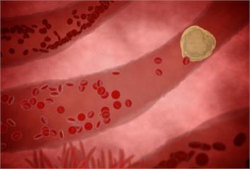 忽視膽固醇險釀大禍  新標準助避開心血管危機