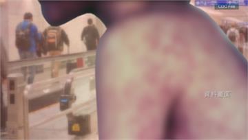 今年第8例！10多歲外籍生染麻疹 匡列162人足...