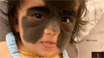 如「蝙蝠俠」面具紋面 父母送女童赴俄除胎記