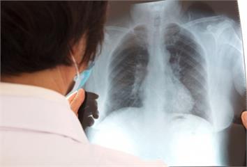 九成結節都非癌！胸腔科醫破解肺癌篩檢迷思：早期發...