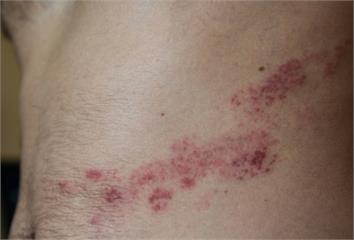 帶狀皰疹像被火燒！神經科醫師警告：劇痛先來、延誤...