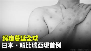 猴痘蔓延全球 日本、賴比瑞亞現首例