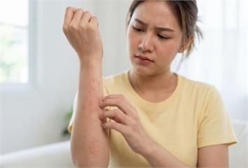 紅疹「不痛不癢」還愈長愈多！她一切片竟是乳癌皮膚...