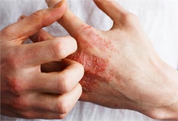 夏季常見2種皮膚疾病  常見在頭皮、鼠蹊部、腋下...