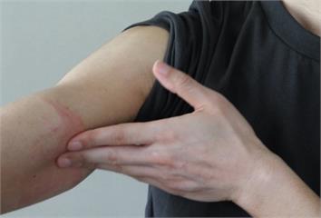 濕疹反覆治不好？醫揭「1習慣」害的  海鮮、甜食...