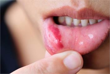 經常嘴破的人有4成是這種疾病患者 透過抽血等檢驗...