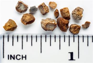 結石痛到想打滾？醫揭形成原因、好發族群與關鍵警訊