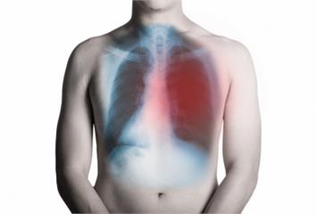 篩檢肺癌為什麼用LDCT比胸腔X光更好呢？影像科...