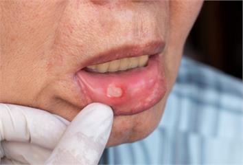 嘴破反覆不癒合 男子就醫驚覺口腔癌第二期
