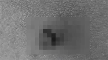 今年首例萊姆病 60多歲女性瑞典遭蚊蟲叮咬感染