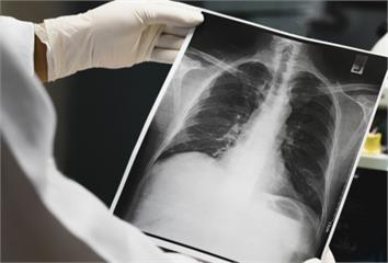 肺病去年死亡人數飆高至3萬 今年流感恐強勢回歸！...