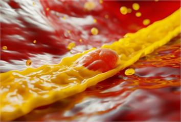 健檢紅字卻沒症狀？小心「三高」悄悄傷血管　醫提醒...