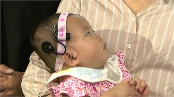 全台首位！女嬰裝雙邊電子耳 健保補助省百萬