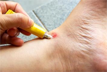 外用類固醇藥膏「這樣用」恐誘發糖尿病！藥師示警 ...