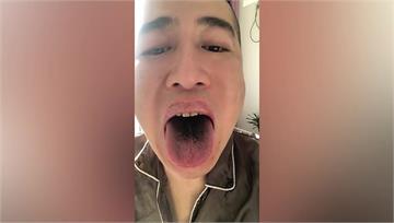 中國民眾染疫後臉、舌發黑　醫師：恐免疫力下降導致