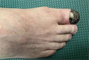 腳趾黑痣別輕忽！76歲翁確診肢端黑色素瘤　醫：黑...