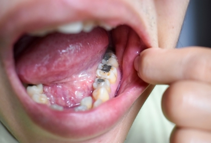 牙周病恐不只傷牙！研究揪「1口腔細菌」 竟與主動脈瓣膜狹窄有關