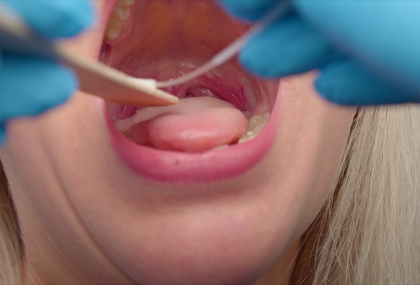 沙粒感、唇腫竟是警訊！運輸司機及早手術阻斷口腔癌風險