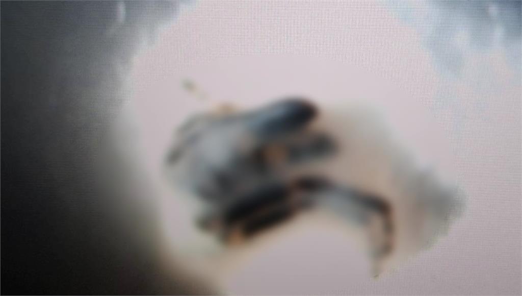 70歲翁午睡「喇牙爬進眼」幾乎睜不開急救醫 醫直呼罕見案例