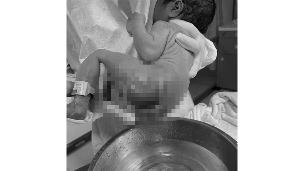 於三總內湖出生的女嬰燒燙傷。圖／翻攝自臉書社團2022虎寶寶媽媽