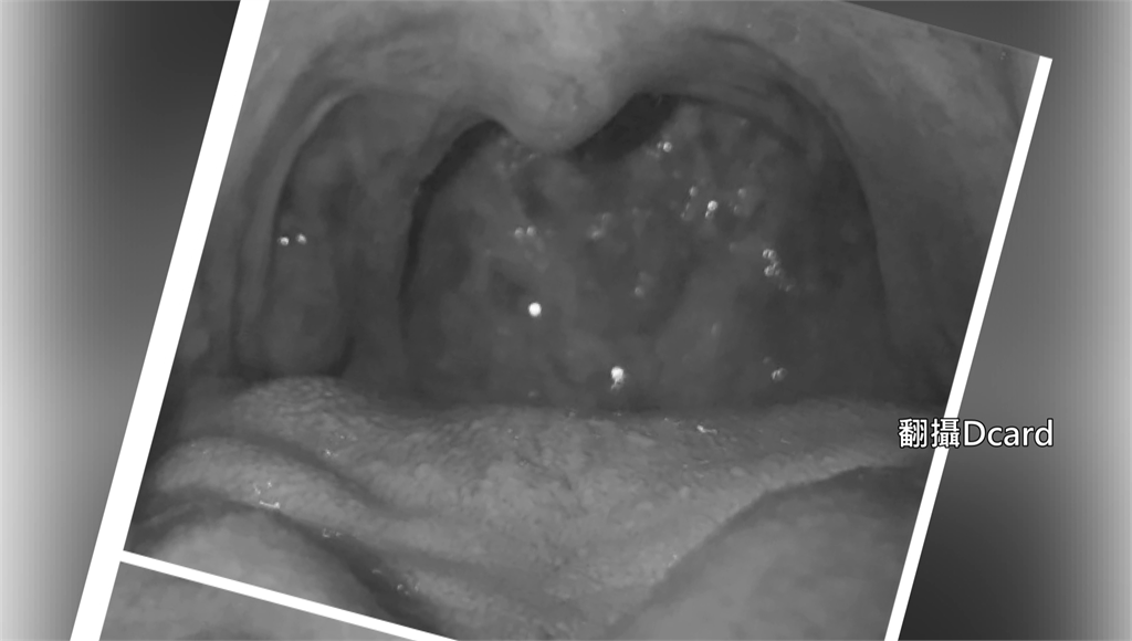 確診者的咽喉壁上，有一粒一粒的顆粒狀，會紅腫痛。圖／台視新聞