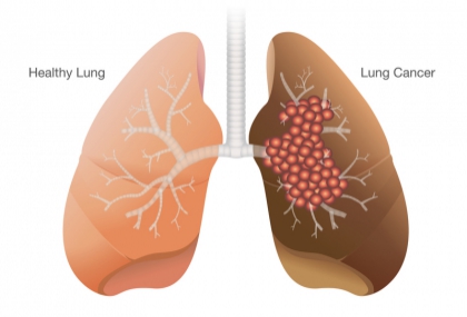 北榮研究：肺癌患者超達95％都有家族史