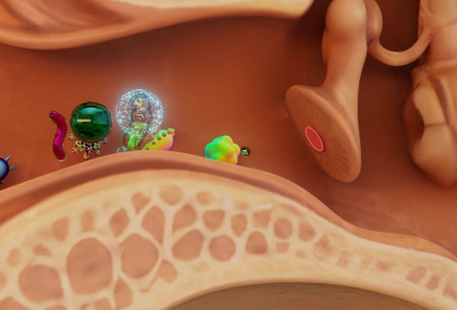 慢性中耳炎未控 75歲翁併發膽脂瘤侵蝕顱底、顏面神經麻痺