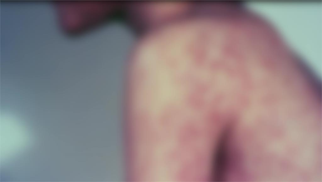 麻疹境外移入病例再+1 北部男印尼旅遊後確診、384人遭匡列