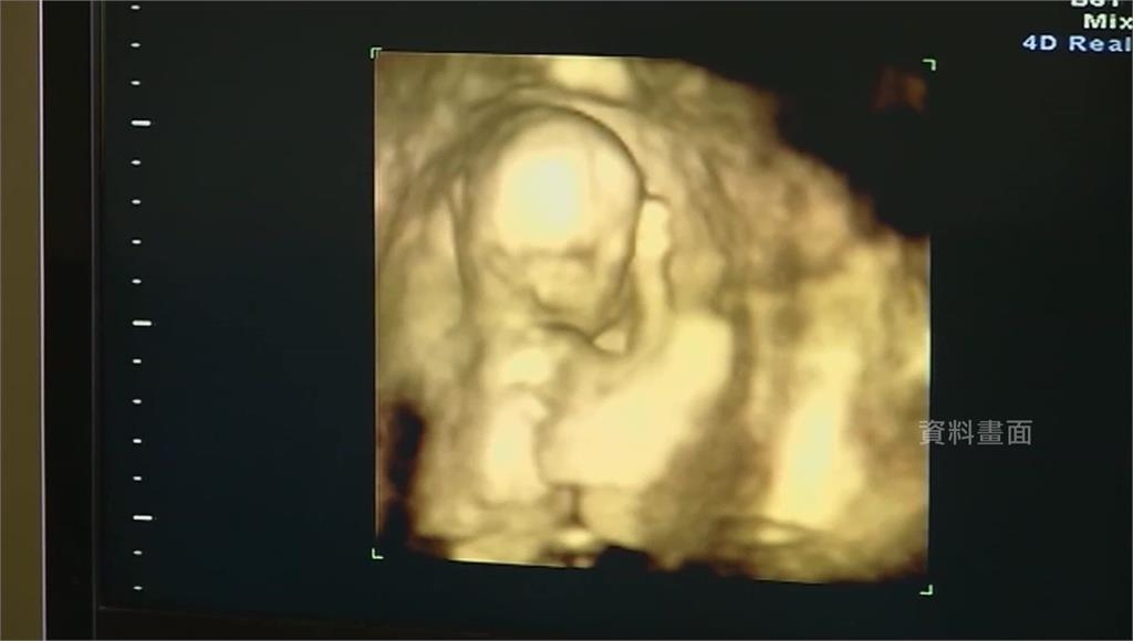 冷凍胚胎視同生命，阿拉巴馬最高院裁定挨批。圖／美聯社（資料畫面）
