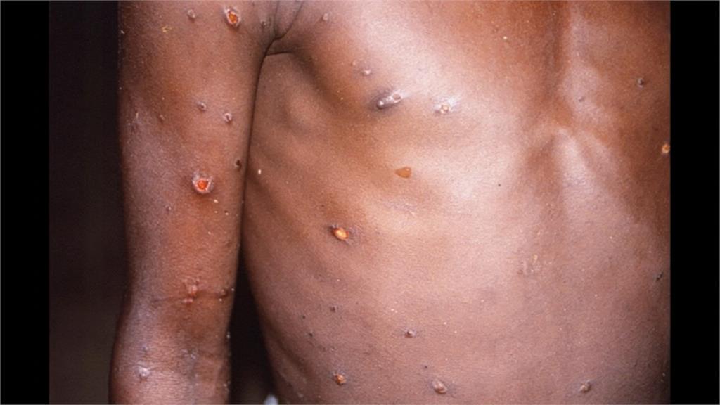 美國CDC表示，猴痘不像新冠病毒，不會透過空氣傳播。圖／翻攝自AP Direct
