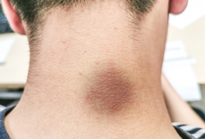 身體「這3處變黑」恐是血糖失控！ 醫嚴厲警告