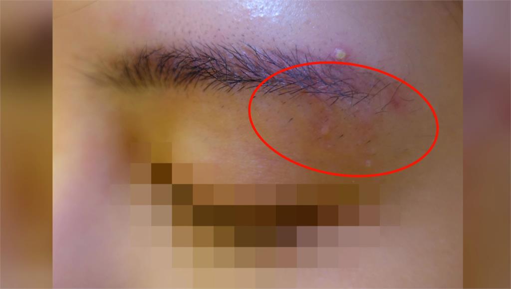 愛美紋眉險毀容，女子逾50肉芽擴散眉與頸部。圖／台視新聞
