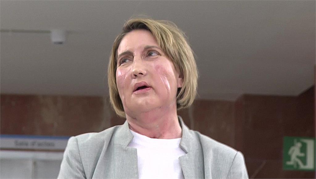 安樂死患者「捐臉」遺愛人間讓毀容女重獲新生 成全球首例移植手術