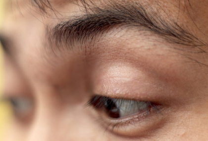 眼皮「這1變化」恐是心肌梗塞前兆　很多人以為只是老了