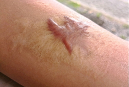 蟹足腫無法根治？掌握這 9 件事 降低發生與惡化風險