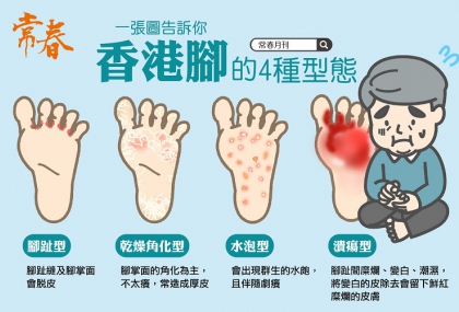 每天穿同雙鞋小心得香港腳 一張圖認識 香港腳4大型態 水泡 厚皮也在內