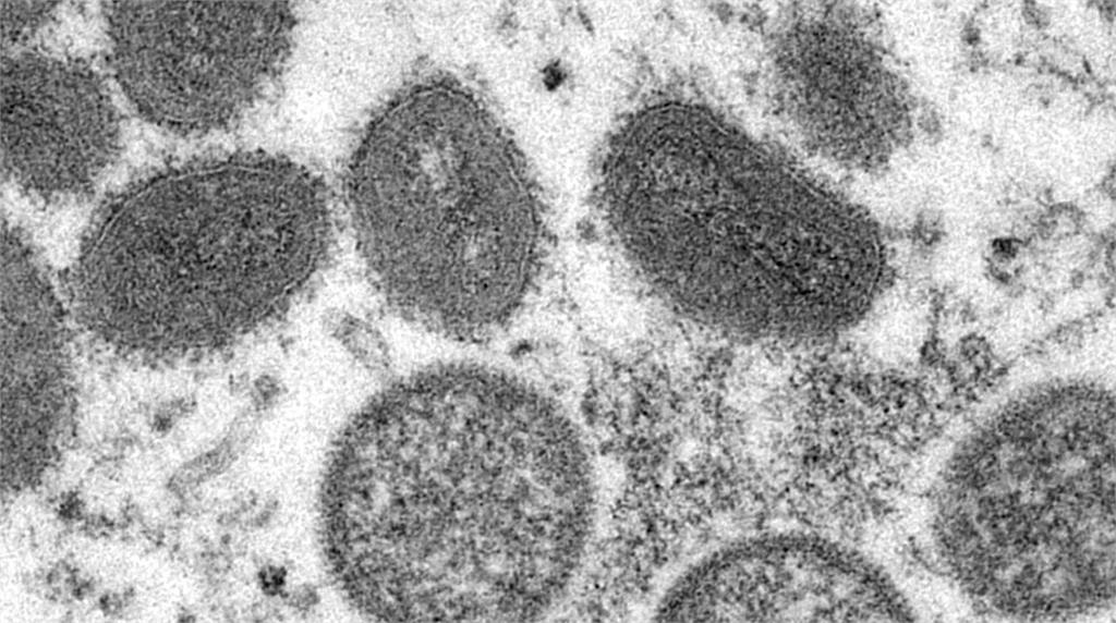 在這波猴痘疫情中，美國累計3846人確診，成為全球病例數最多的國家。圖／美聯社（資料畫面）