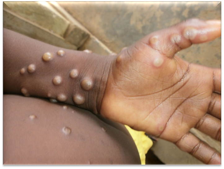 歐洲疾病預防控制中心警告，如果猴痘在動物群體中傳播，可能會演變成歐洲的地方流行病。圖／翻攝自WHO